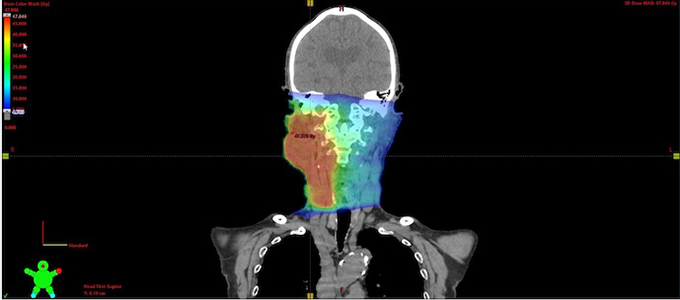 頭頚部 IMRT