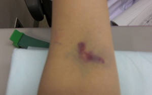 Image of after blood collection