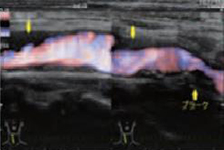 Arteriosclerosis image