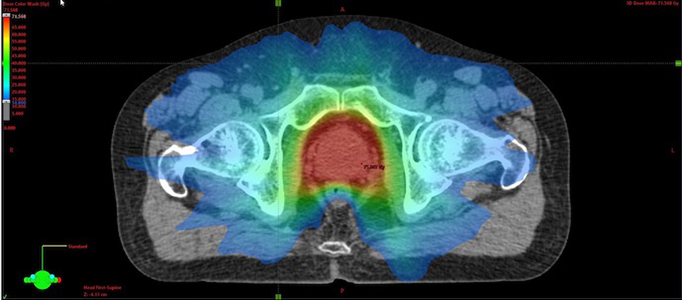 Prostate IMRT