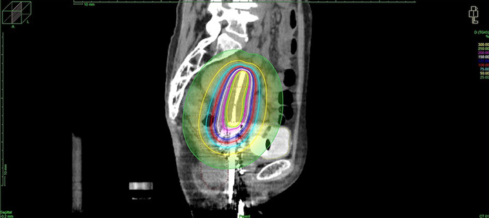RALS Sagittal section image